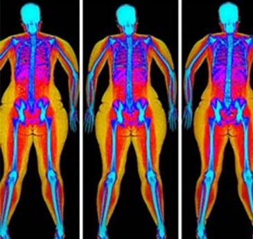 An x-ray of the body showing fat accumulation