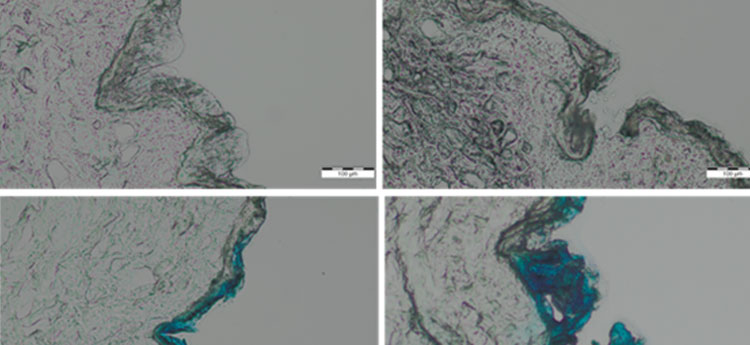 four images of histological section of human skin showing responses to microneedle treatment