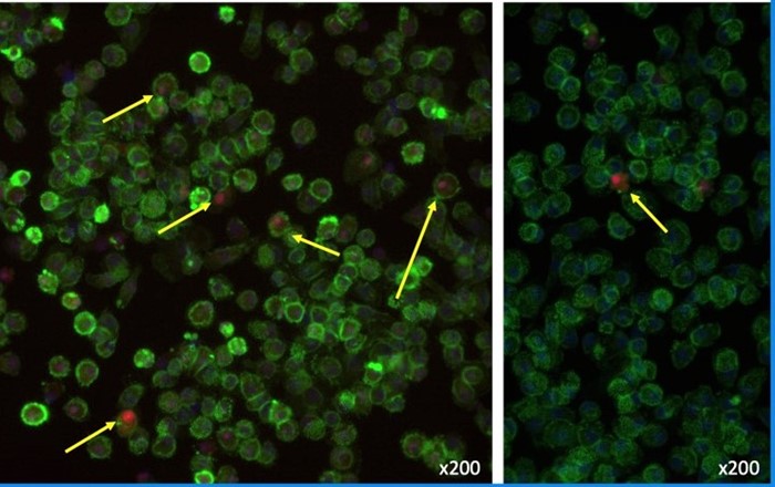 Left: white blood cells (coloured green and blue) isolated from human blood that have been fed with human myelin (red) to mimic myelin breakdown seen in MS. Arrows point to some cells which have ‘eaten’ the myelin. Right: the same cells after treatment