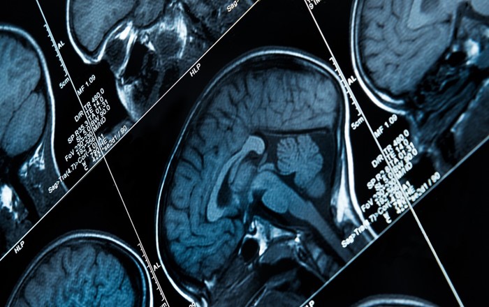 Brain scan: epilepsy is a serious neurological condition that can affect anyone, at any age and from any walk of life.